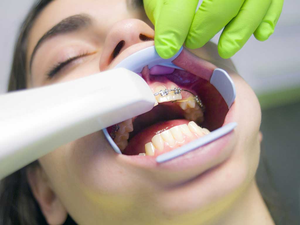 어린이 교정 치아보험 사례(2)